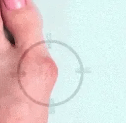 Set de 2 Separatoare Din Gel Silicon Pentru Degetele De La Picioare, Protectie Impotriva Monturilor Si Durerilor